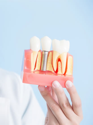 implant restorations